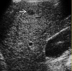 Cirrhosis Imaging Ultrasound primary