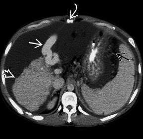 CT small nodular liver with