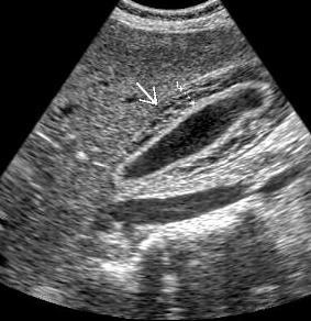 Hepatitis Imaging Ultrasound Hepatosplenomegaly