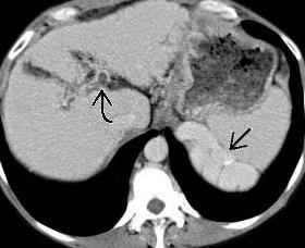 Cirrhosis Complications Hepatocellular carcinoma Triple phase CT or MRI