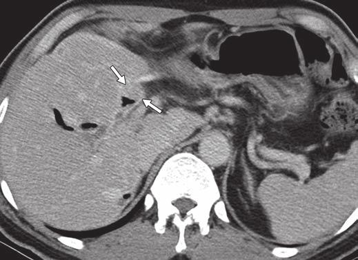 A and, Contrast-enhanced CT images show oval cystic mass containing multiple papillary tumors and