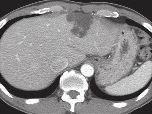 Imaging of ile Duct Papillary Neoplasms Fig. 2 46-year-old man with intraductal papillary neoplasm of the bile duct (carcinoma, confined to wall).