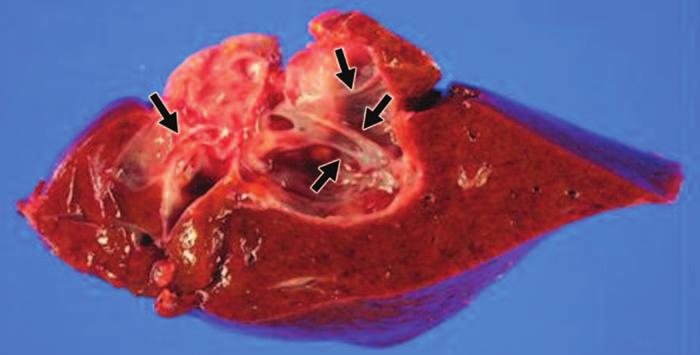 C, Resected specimen shows multiloculated cyst containing thin septae and flat tumor with papillary surface (arrows).