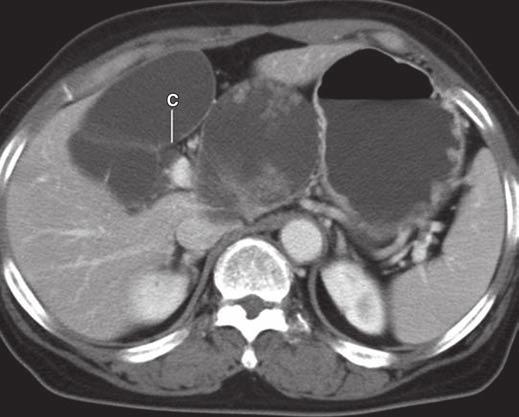 In six patients, cystic tumors involved segmental bile ducts: the right posterior segmental bile duct in one patient, the lateral segmental bile duct of the left lobe in four patients, and the