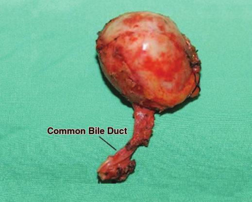 In two cases, multilocular cystic lesions were the cystically or aneurysmally dilated right and left hepatic ducts per se, and the dilated ducts were lined by innumerable papillary tumors and