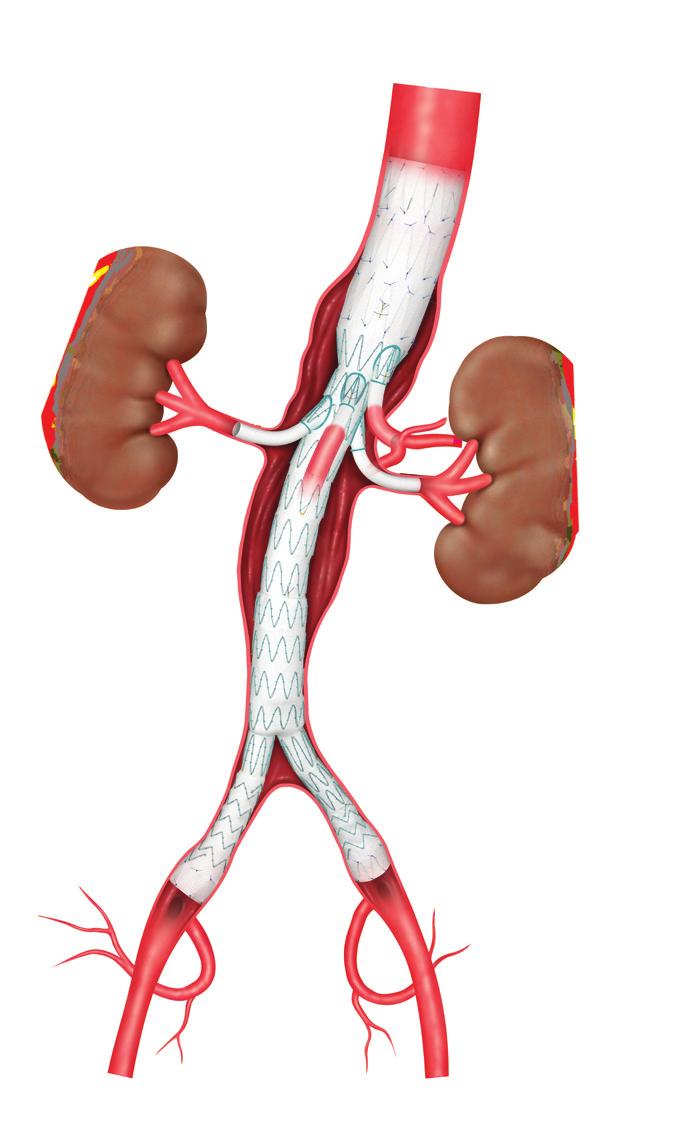 What is an endovascular repair? Endovascular means inside or within a blood vessel.