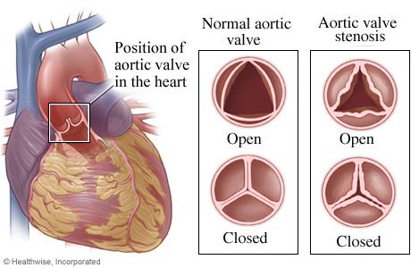 362 Calcific Aortic Valve Disease disease) usually have extensive atherosclerosis involving the major epicardial coronary arteries and usually other systemic arterial systems; 4) that serum total