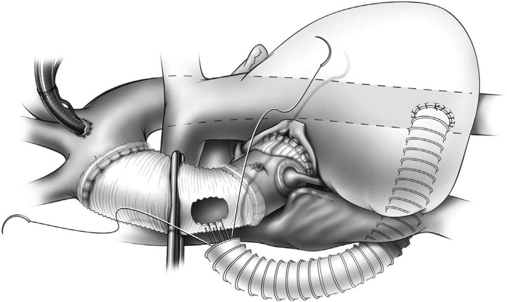 the right lateral aspect of the aorta. 3 Figure 15 The aortic root is replaced with an aortic root bioprosthesis. The aortic graft is anastomosed to the aortic root bioprosthesis.