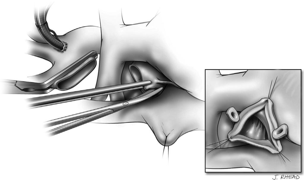 Stentless aortic bioprosthesis 187 Figure 2 The aortic valve is excised and calcareous deposits are removed from the aortic root.