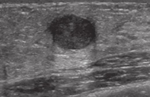 Imaging of Breast Abnormalities A Fig.