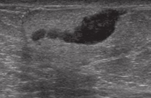 Lehman et al. Fig. 5 (continued) 55-year-old woman with palpable left breast lump and associated ecchymosis.