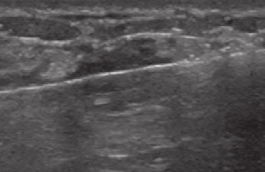 A, Targeted ultrasound image at site of clinical concern shows 12-mm solid mass with oval shape, partially circumscribed