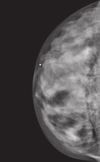 Imaging of Breast Abnormalities A B D Fig.
