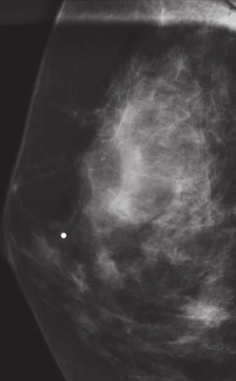 dense breasts and oval mass with partially circumscribed, partially