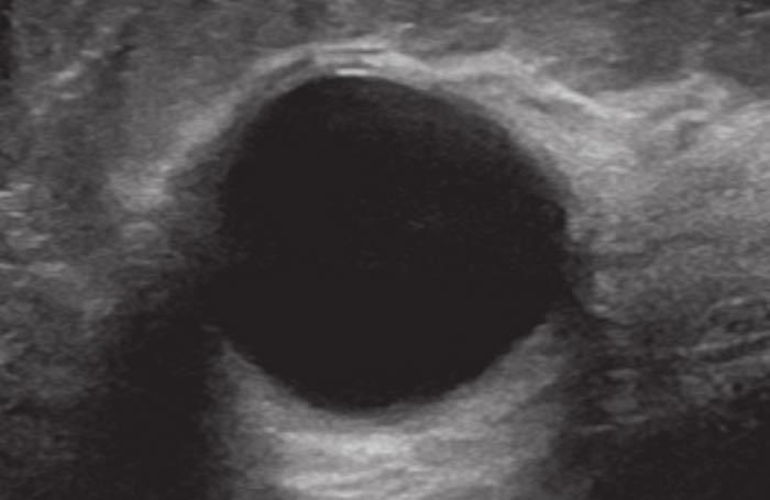 D, Targeted ultrasound image at site of clinical concern shows 28-mm