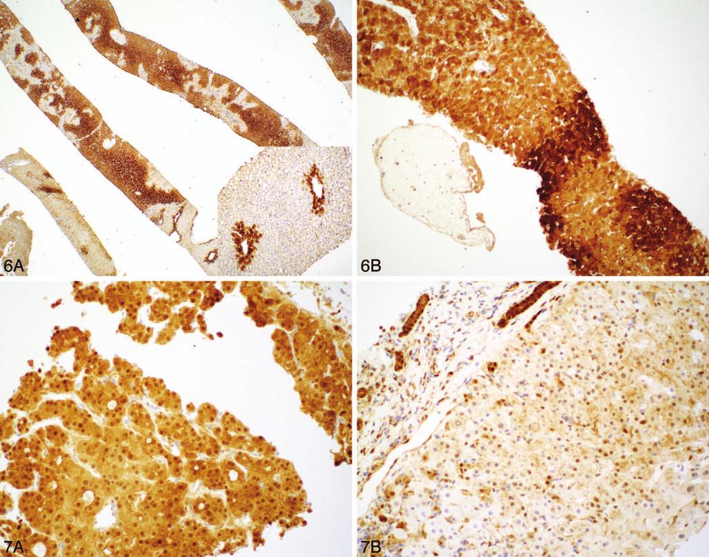 Figure 6. Immunostaining for glutamine synthetase shows a characteristic maplike pattern for focal nodular hyperplasia on a liver core biopsy (A).