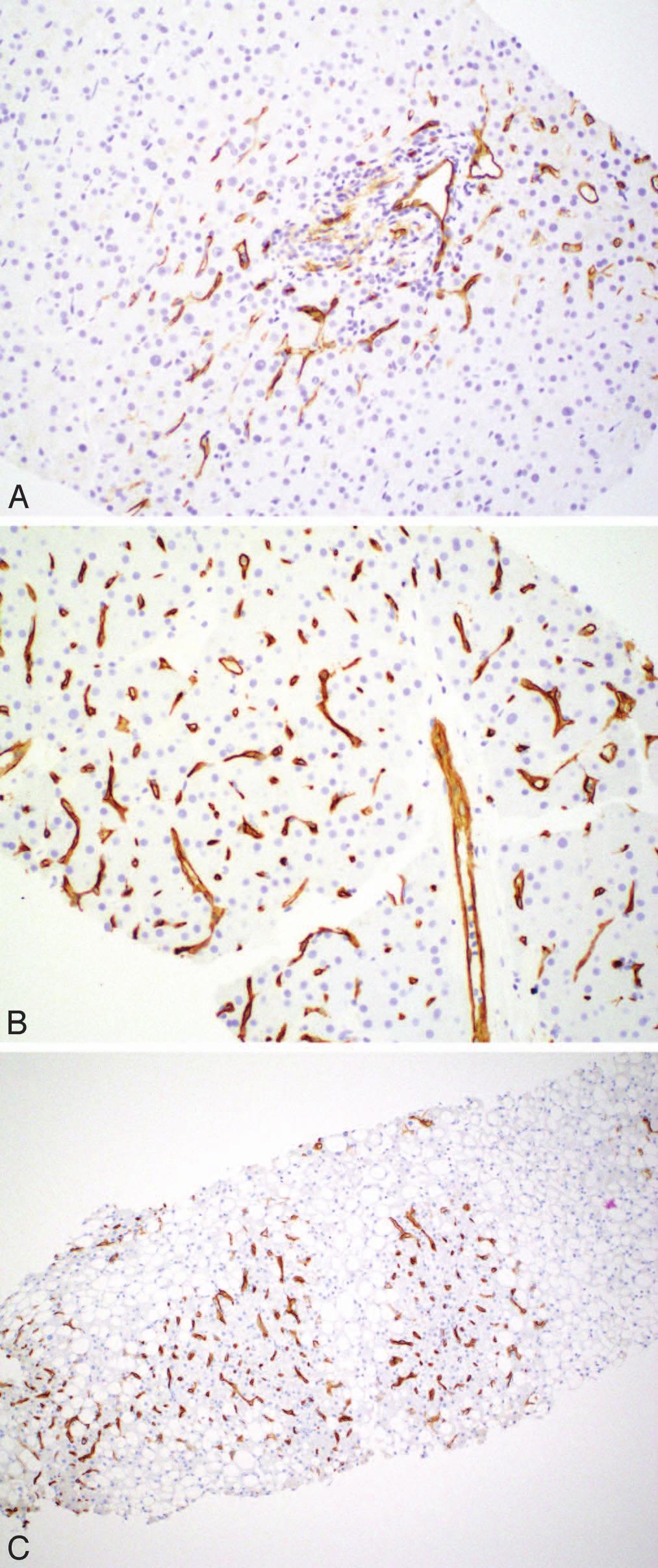 Figure 9. Clusterin shows an enhanced canalicular staining pattern in a hepatocellular carcinoma (A) but a delicate, granular canalicular pattern in adjacent nonneoplastic (cirrhotic) liver (B).