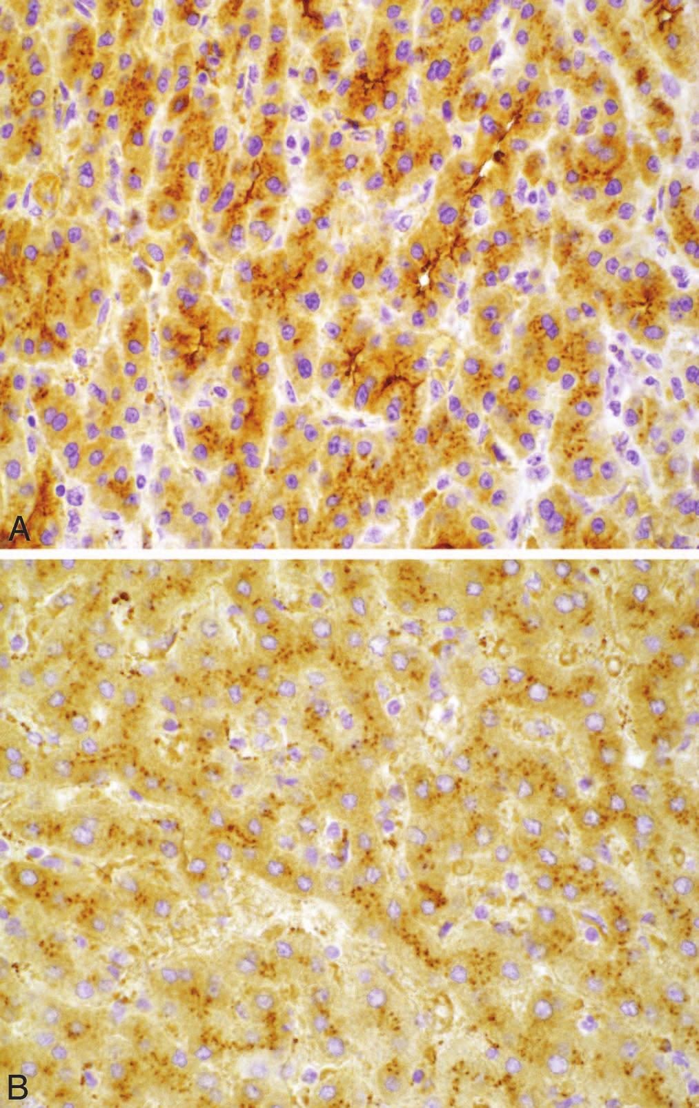 CD34 highlights portal vasculature and sinusoids immediately adjacent to portal tract in nonneoplastic liver (A), but it shows a diffuse (also termed complete ) sinusoidal staining pattern (B) in