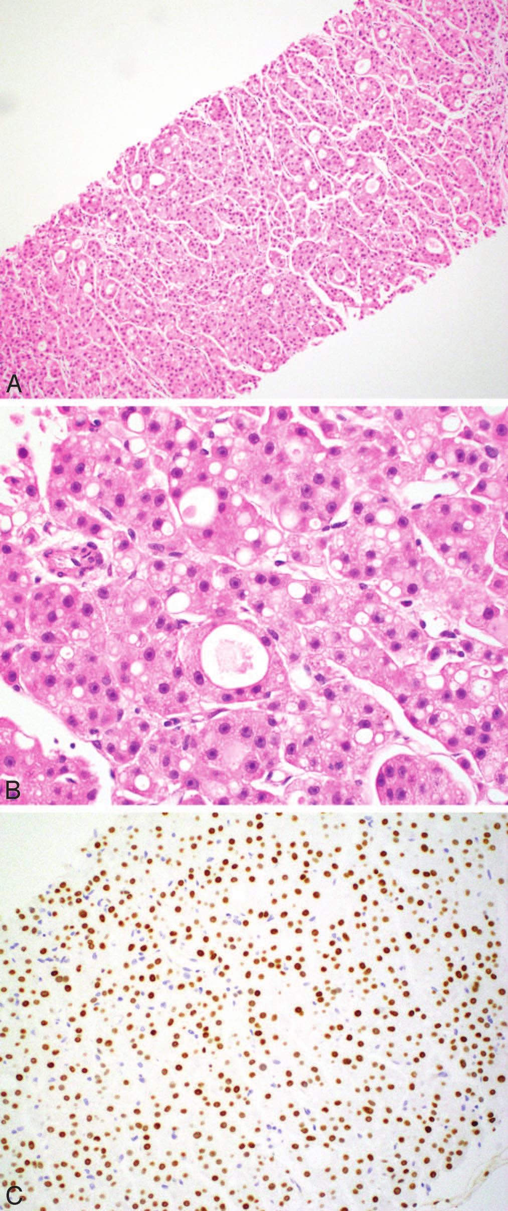 Hep Par 1 (38%). 159 A high proportion of hepatoid carcinomas are also positive for pancytokeratin AE1/AE3 (92%) and GPC3 (100%). Canalicular pcea and CD10 stains are seen in two-thirds of cases.