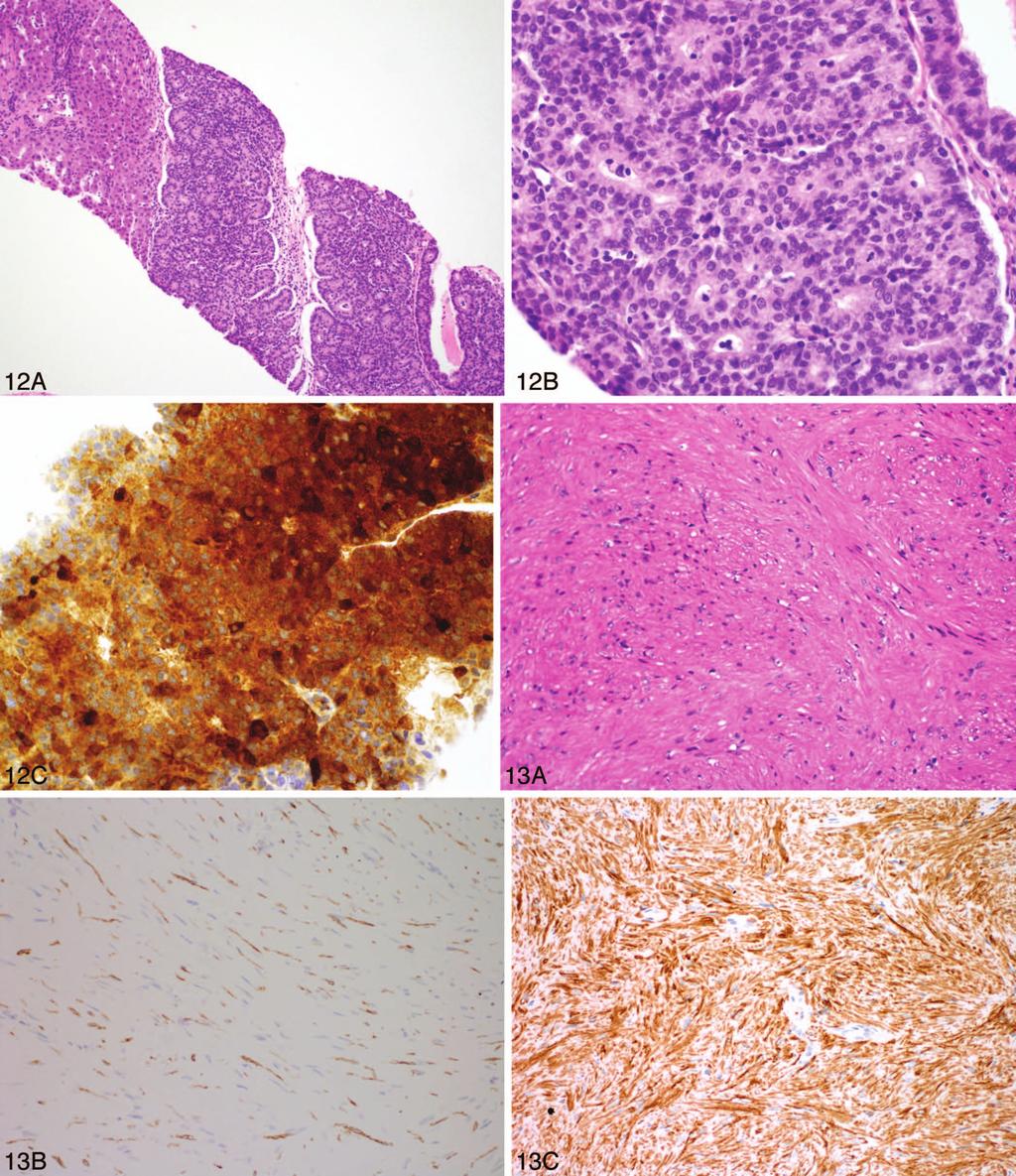 Figure 12. A liver biopsy shows an area of tumor cells with acinar formation (A). Tumor cells have round, uniform nuclei, small nucleoli, and amphophilic cytoplasm (B).