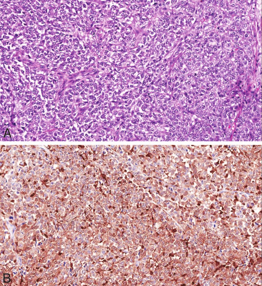 General Immunomarkers for GIST Gastrointestinal stromal tumor is immunophenotypically related to interstitial cells of Cajal, the pacemaker cells of the GI tract.