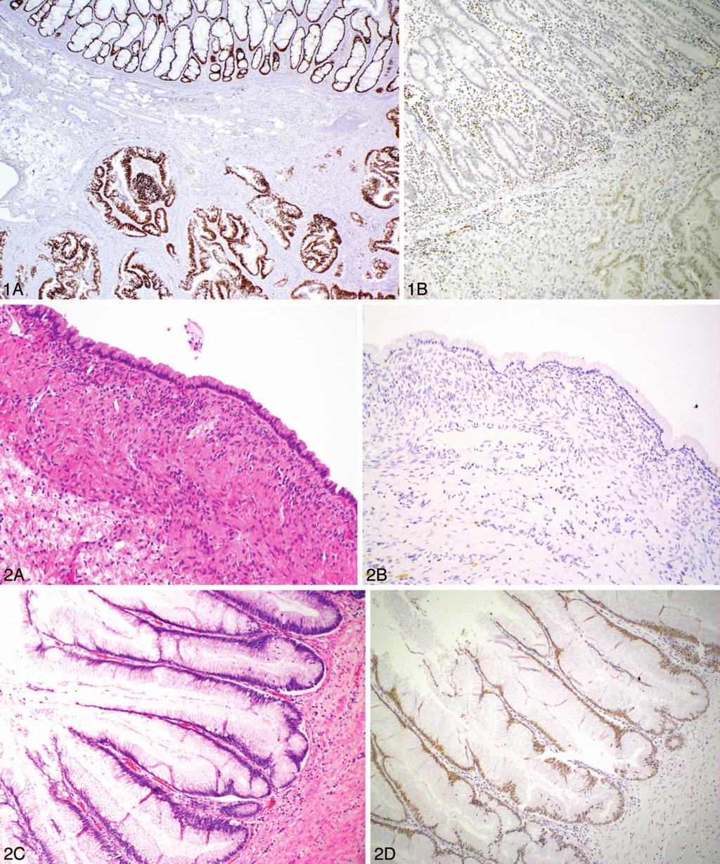 Figure 1. Strong and diffuse SATB2 expression in colorectal adenocarcinoma (A), but patchy and weak expression in small intestinal adenocarcinoma (B).