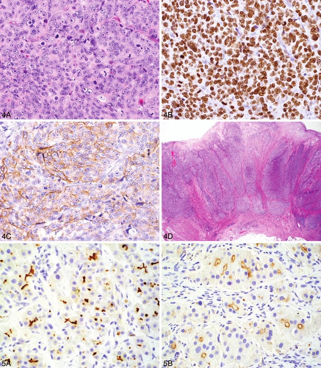 Figure 4. A biopsy of a right colon mass shows poorly differentiated carcinoma on histologic examination (A). By immunohistochemistry, tumor cells are positive for SATB2 (B) and CDH17 (C).