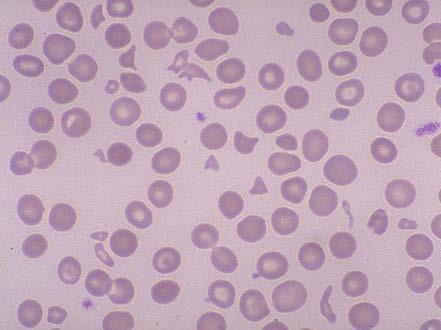 Schistocytes in