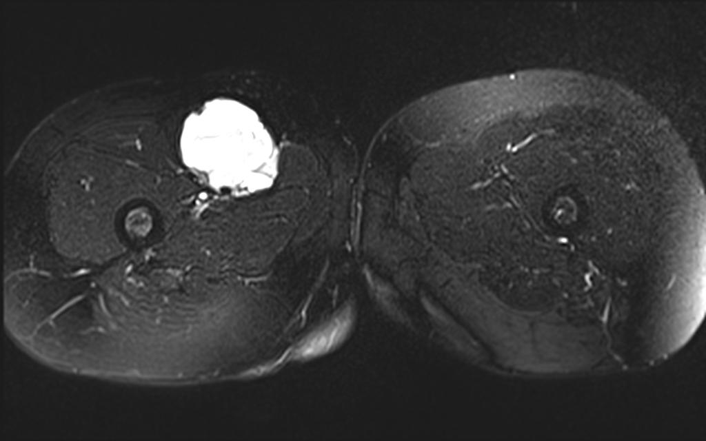 Fig. 6: Low-flow malformation of the right thigh. High signal intensity on the T2-weighted turbo spin-echo image.