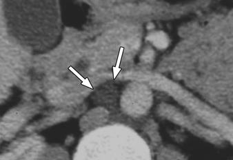 oronal maximum-intensity-projection image shows prominent lumbar trunks (arrows) on both