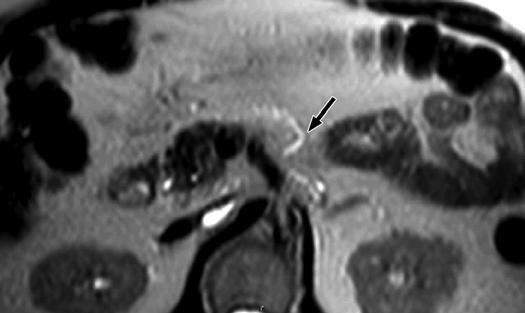 3 xial single-shot turbo spin-echo (HSTE) sequence in 63-year-old man who underwent MRI