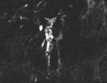 4 58-year-old woman who underwent MRI for cholangitis.