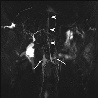 retrocrural (arrowhead) lymphatic trunks is seen.