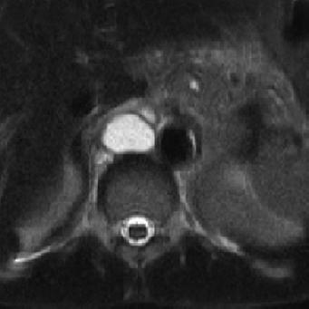 9 61-year-old man who underwent MRI after surgery for gastric cancer.