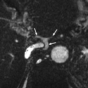 chylous ascites (asterisks) and retroperitoneal chylous collection (arrows).