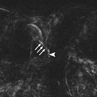 trunk that pierces diaphragmatic crus () between inferior vena cava and aorta