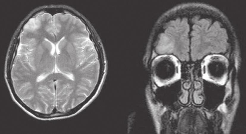 A RI Figure 1. T2-weighted, axial, and fluid-attenuated inversion recovery coronal magnetic resonance imaging scans showing a well-defined focal mass lesion in the right frontal lobe. Figure 2.