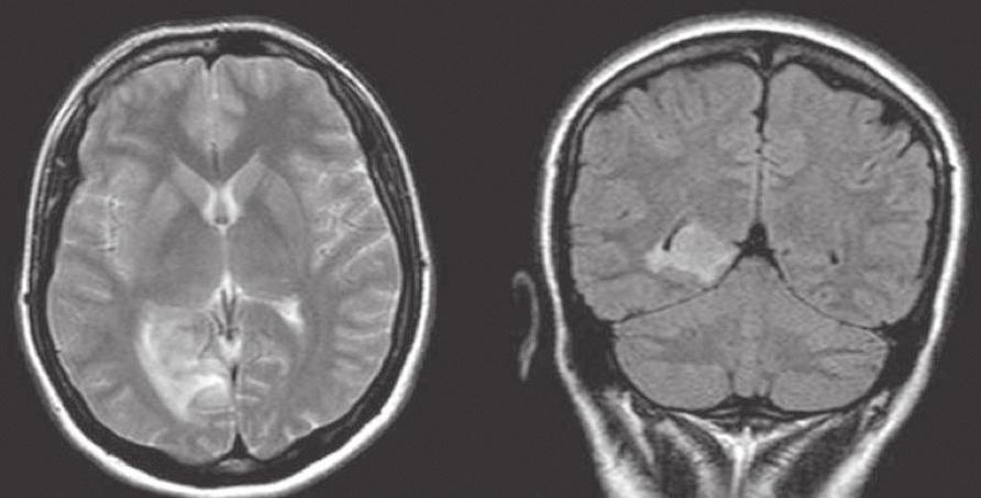 tent with a low-grade astrocytoma (Figure 1). Stereotactic biopsy was, then, performed. The biopsy result was consistent with a low-grade astrocytoma.