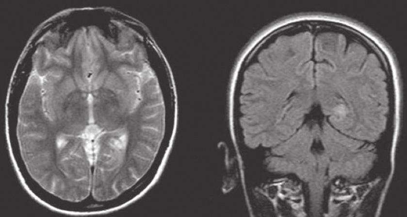 Migraine-like visual aura: Can it be an early-onset symptom of astrocytoma? Figure 3.