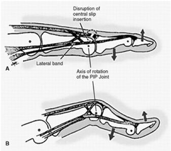 Pathomechanics of Disruption of central slip Lateral bands migrate palmar to axis of rotation of PIP due to attenuation of triangular ligament