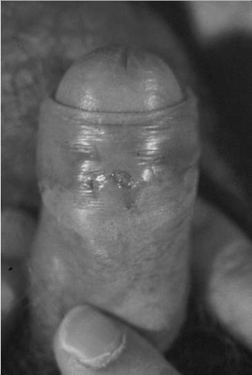 women - perirectal and pelvic LN involvement In women, lymphatic spread from the cervix and posterior vaginal wall Early fleshy nodes show diffuse reticulosis; later -