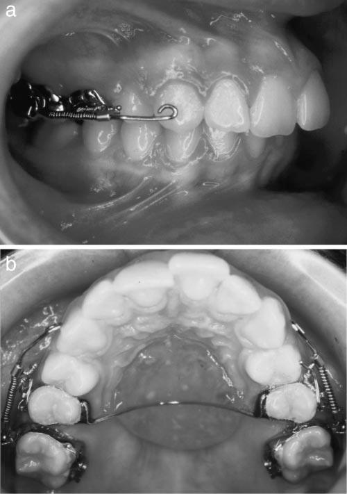 3D ANALYSIS OF NONCOMPLIANCE MOLAR DISTALIZATION dental casts and used various methods of two-dimensional assessment.