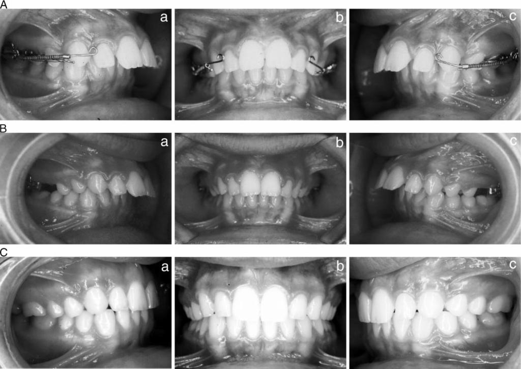 536 MAVROPOULOS, KARAMOUZOS, KILIARIDIS, PAPADOPOULOS TABLE 2. Evaluation of Movement of All Teeth Under Investigation After the Use of the Noncompliance Molar-distalizing Intraoral Appliance.