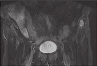 DWI in coronal plane shows impeded diffusion in the left iliac bone. C. Fat saturated T2W coronal image demonstrates high signal intensity in the left iliac bone. fied.