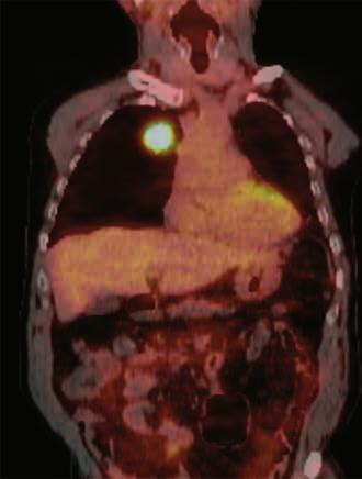 344 JBR BTR, 2014, 97 (6) A B C Fig. 2. 57-year-old male patient with primary lung cancer in the right upper lobe with no metastasis. A. PET-CT image on coronal plane demonstrates pathologic FDG uptake in the mass lesion corresponding to primary lung cancer in the right upper lobe.