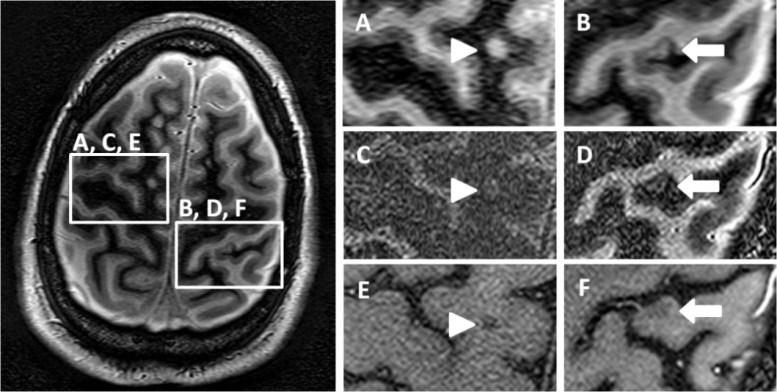 analysis. Figure 2.2: High SNR white matter attenuated IR-TFE images showing an example white matter lesion (A, arrowhead) and cortical lesion (B, arrow).