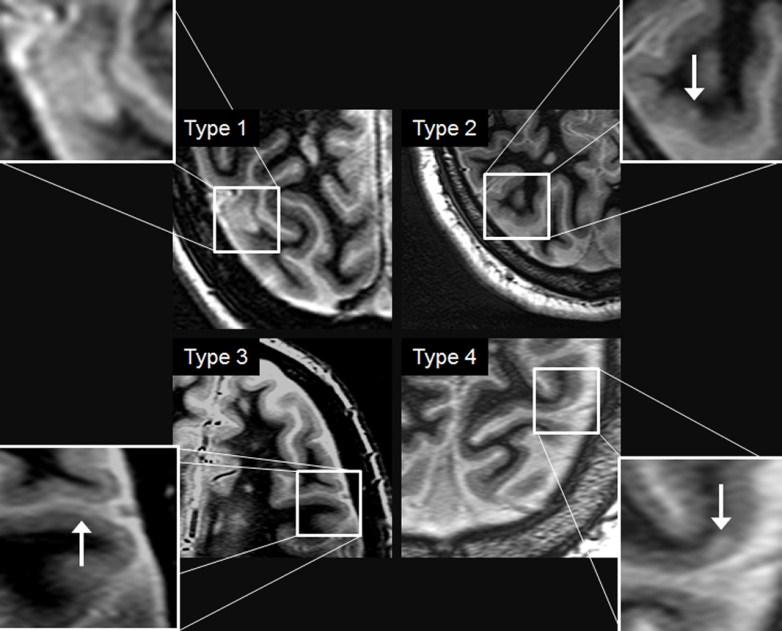 Figure 3.4: Examples of type I, II, III and IV cortical lesions showing their appearance in WHAT images. WHAT Sequence Parameter Optimization Figure 3.
