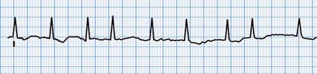 U-wave =hypokalemia and hypomagnesemia Very prominent = increased susceptibility to torsades de pointes Negative U waves, ( V4-6) = in acute Mischemia +LVH QT interval