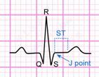 7 ST segment J junction= point at which the QRS complex ends and t ST segment begins; cannot be easily discernible during rapid heart rates and hyperkalemia.