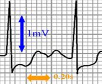 8 T wave = deflection produced by ventricular repolarization.